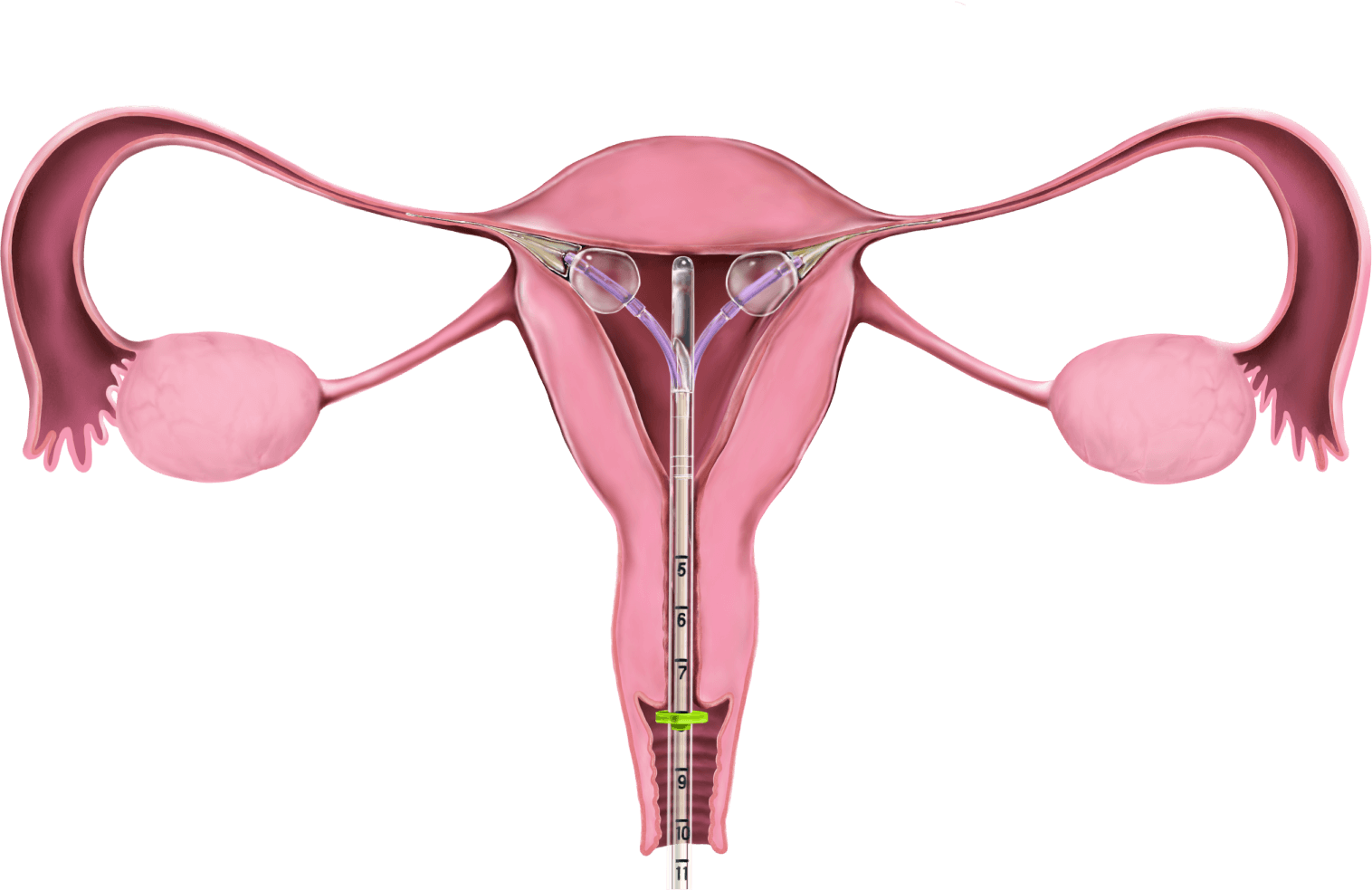 FEMBLOC diagram 3
