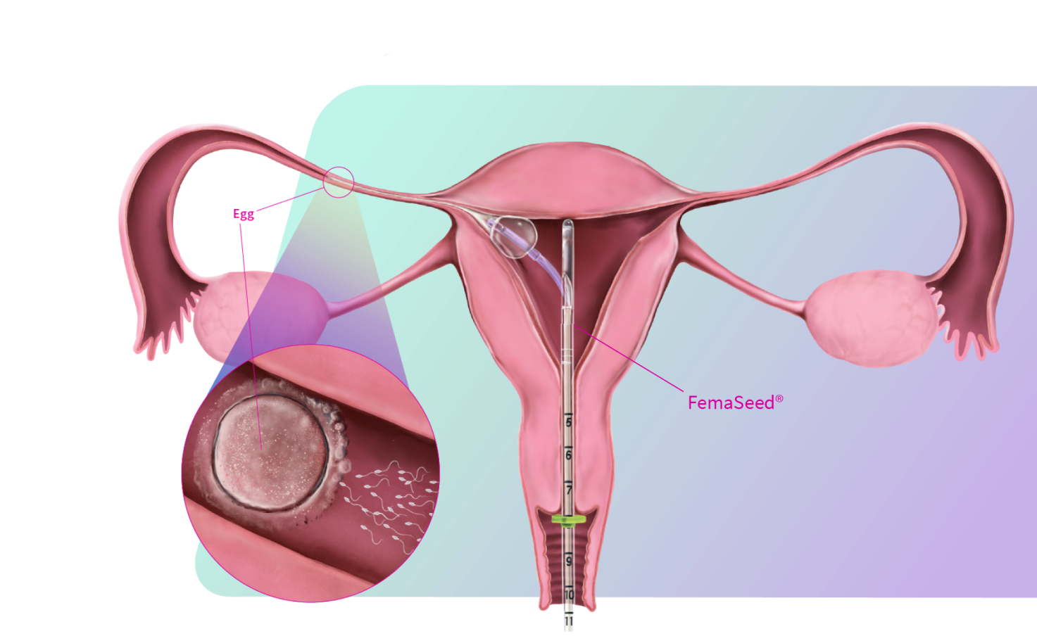 Mechanism of action showing FemaSeed Intratubal Insemination.