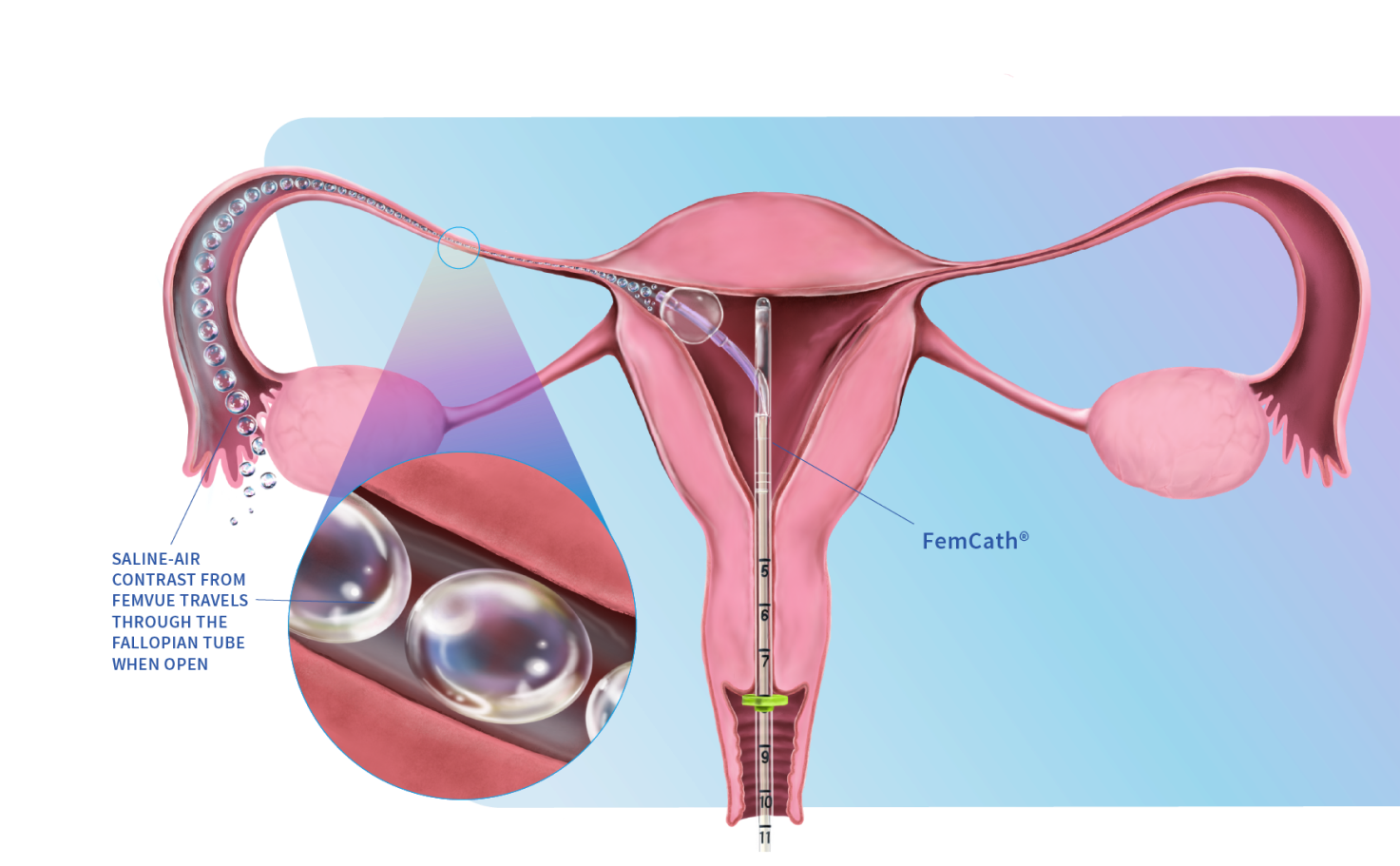 Mechanism of action showing FemVue with FemCath.